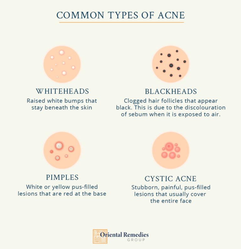 Understanding and treating acne, maskne, back acne the TCM way ...