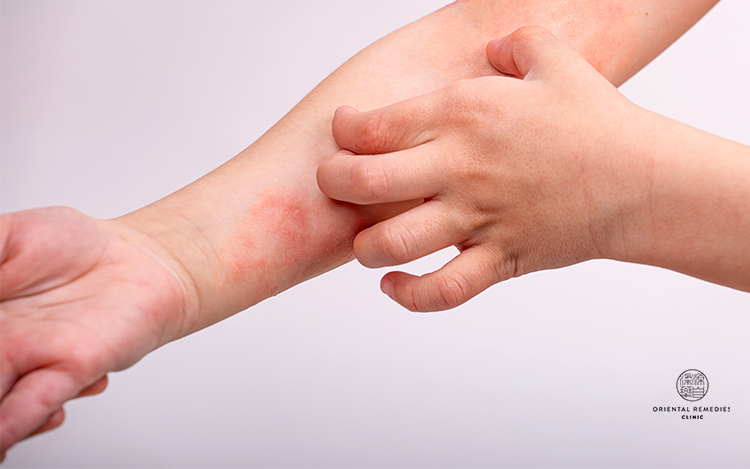 Treating Paediatric Eczema With TCM | Oriental Remedies Clinic